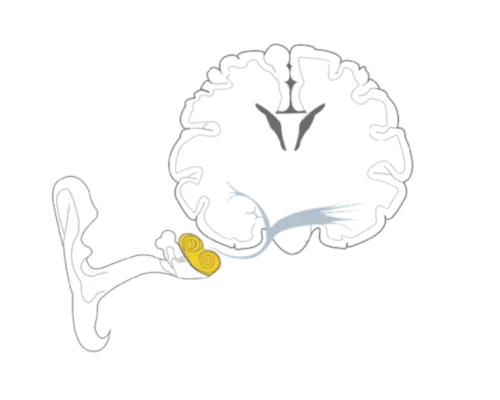 sensorineural-hearing-loss-1000-1000